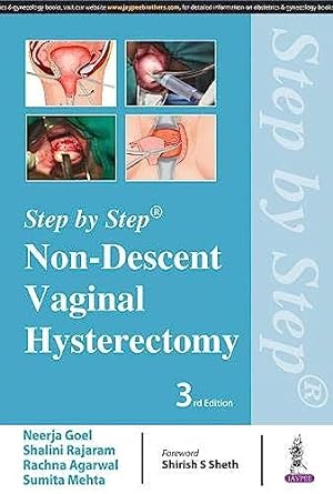 Step by Step Non-Descent Vaginal Hysterectomy