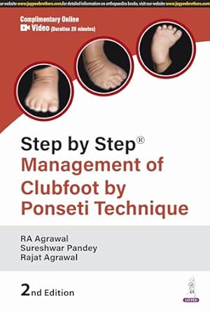 Step By Step Management of Clubfoot By Ponseti Technique